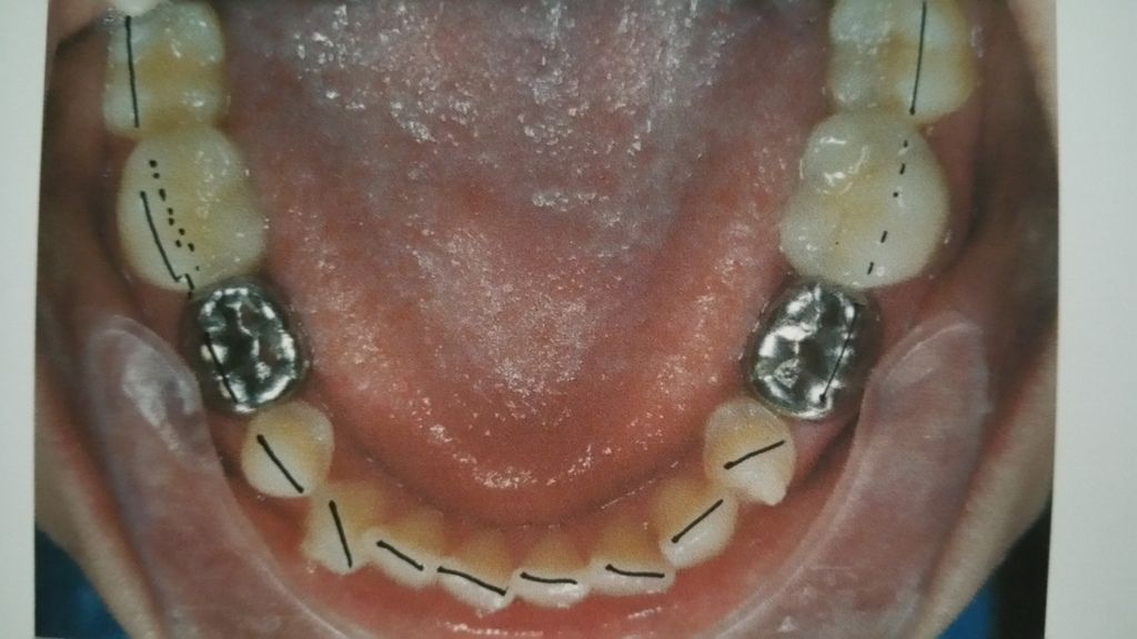 Braces and Palate Expander at 20 Years Old Metal Mouth Message Board
